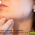 Gallmet against psoriasis