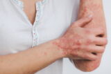 psoriasis, psoriasis treatment