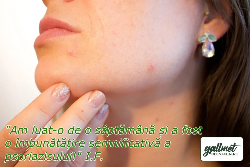 Efectele benefice ale acizilor biliari asupra psoriazisului