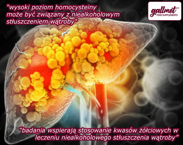 leczenie niealkoholowego stłuszczenia wątroby