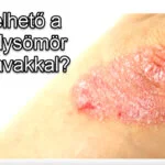 Psoriasis-Behandlung mit Gallensäuren