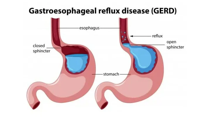 reflux